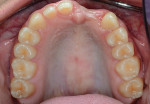 Fig 6. Occlusal view illustrating missing teeth, diastemas, and labial concavity of ridge.