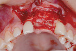 Fig 8. Graft of ridge covered with resorbable collagen membrane prior to implant placement.