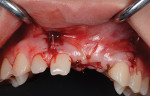 Fig 9. Buccal view of closure, with normal volume restored to ridge.