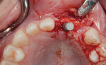 Fig 11. Implant placement.