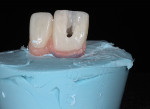 Fig 12. Modification of impression coping to duplicate subgingival contour achieved around implant by provisional.