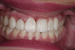 Fig 13. Provisional bridge and veneers used to allow patient to comprehend the utilization of pink acrylic and veneers to achieve a more ideal pink/white ratio.