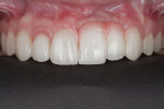 Fig 16. Retracted view of restorations demonstrating improved length-to-width ratios and the blending of the pink porcelain with adjacent gingiva.