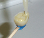 Figure 19  A wax stick applicator was attached to the onlay, and the casting was loaded and seated onto the preparation.