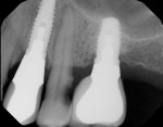 Fig 3. Tooth No. 13 showed caries on the distal aspect where the distance to implant No. 14 (ITD) was more than 4 mm. Note there was no caries on the mesial surface of tooth No. 13 where the ITD to implant No. 12 was less than 3 mm.