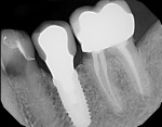 Fig 5. Decay was present at margins of previous restorations on teeth adjacent to molar implants.