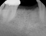 Fig 10. In a single healed molar extraction site where the ridge was too narrow to place one wide implant (Fig 10) two 4.1-mm diameter implants were placed (Fig 11). The distance between the teeth at the level of the alveolar crest was 14.5 mm and the width of the ridge was 6.8 mm. Placing two narrower implants allowed the ITD to the adjacent teeth to be minimized. This case may be restored as either two bicuspids or one molar with a small cleansable embrasure between the implants.