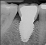 Fig 8. Placement of an 8-mm diameter implant with a 6.5-mm platform immediately upon extraction of tooth No. 30 (Fig 8) resulted in excellent crown contours, minimal gingival embrasure space, and reduced ITD (Fig 9).
