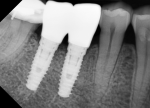 Fig 11. In a single healed molar extraction site where the ridge was too narrow to place one wide implant (Fig 10) two 4.1-mm diameter implants were placed (Fig 11). The distance between the teeth at the level of the alveolar crest was 14.5 mm and the width of the ridge was 6.8 mm. Placing two narrower implants allowed the ITD to the adjacent teeth to be minimized. This case may be restored as either two bicuspids or one molar with a small cleansable embrasure between the implants.