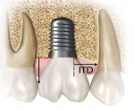 Fig 1. Measurements were taken vertically from implant platform to base of contact area, and horizontally from abutment/platform connection to adjacent root surface (ITD).