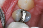 Figure 1  Preoperative image showing the old amalgam restoration.