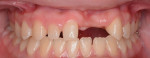 Fig 3. An intraoral view shows the missing teeth and ridge vertical height deficiency.