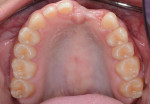 Fig 6. The occlusal view illustrates missing teeth, diastemas, and labial concavity of ridge.