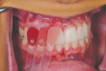 Fig 15. Shade tabs are used to evaluate the different depths and shades in the gingival color.