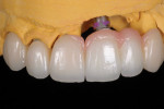 Fig 16. Working from the cast, the laboratory incorporates gingival ceramic on both the implant bridge and the veneer.