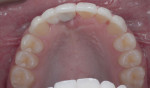 Fig 18. The final bridge and veneers are shown in this occlusal view.