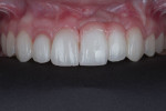 Fig 19. A retracted view of the restorations demonstrates the improved length-to-width ratios and the blending of the pink porcelain with adjacent gingiva.