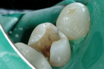 Figure 6  Buccal crack into the dentin was completely removed with a small round diamond.