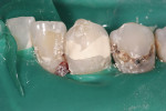 Figure 4  Canine axial wall pulp-capped and restored with Biodentine.