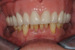 Fig 14. Six-year postoperative follow-up (May 16, 2019), buccal (Fig 14), lower left quadrant (Fig 15), lower right quadrant (Fig 16). The patient had maintained excellent plaque control and compliance to an alternating periodontal maintenance schedule every 3 months. Note significant increase in the zone and thickness of the attached keratinized gingiva, with “creeping attachment” observed on the treated teeth on each side (Nos. 20 through 22 and 27 through 29).