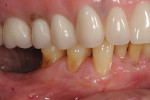Fig 16. Six-year postoperative follow-up (May 16, 2019), buccal (Fig 14), lower left quadrant (Fig 15), lower right quadrant (Fig 16). The patient had maintained excellent plaque control and compliance to an alternating periodontal maintenance schedule every 3 months. Note significant increase in the zone and thickness of the attached keratinized gingiva, with “creeping attachment” observed on the treated teeth on each side (Nos. 20 through 22 and 27 through 29).