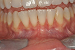 Fig 17. Case 2: Patient exhibited a very thin phenotype. No inflammation or pocket depth was present, and very minor recession was noted on teeth Nos. 23 through 26. There was no attached gingiva on teeth Nos. 22 through 27, and a prominent midline frenum was observed.