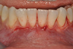 Fig 18. A submarginal partial-thickness incision was made slightly coronal to the mucogingival junction, with an effort to incorporate some keratinized tissue into the flap and leave marginal tissue intact.