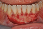 Fig 19. The partial-thickness incision was fully developed into the vestibule, with careful removal of all loose connective tissue. Tissue fenestration over teeth Nos. 22 and 23 was observed.
