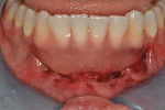 Fig 22. Periodontal surgical dressing was adapted over the surgical site and cured into place to protect the wound.
