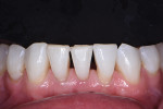 Preoperative photograph with a contrasting background to fully show the dimensions of the black triangles that resulted from congenitally missing tooth No. 26 and adult orthodontic treatment.