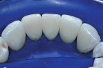 Lingual view of the completed case with the dam still in place, demonstrating proper anatomic shapes and a smooth polish that would feel natural to the tongue.