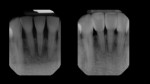 Preoperative (left) and postoperative (right) radiographs reveal the intimate adaptation achieved by the matrices that led to the favorable tissue responses.