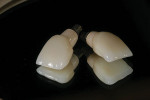Cement-retained implant crown with custom metal-ceramic abutment.