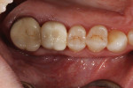 Occlusal view of a screw-retained crown. The screw head has been blocked and the access hole sealed with composite resin.