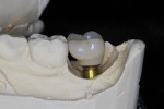 Screw-retained crown with limited vertical height for a second molar.