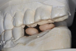 Fabrication of screw-retained crowns. Note the limited occlusal clearance.