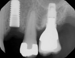 Fig 6. Periapical radiograph showing clinical scenario in which the thickness of the soft tissue is preventing complete seating of the impression coping.