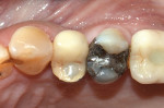 Fig 10. Final crown delivered, occlusal view.