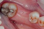 Insufficient keratinized tissue on the buccal aspect of a planned implant site that would
be further minimized should bone exposure be performed with a tissue punch or midcrestal incision.