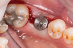 Following implant placement, a healing abutment was inserted to hold the buccally repositioned keratinized tissue in place during the implant healing phase.