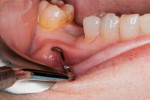An instrument pushes up on the mucogingiva to better illustrate the minimal band of keratinized tissue inferior to the crestal buccal line angle.