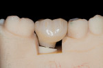 The final laboratory-fabricated, screw-retained
restoration demonstrating an ideal emergence profile on the soft-tissue model.