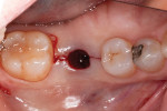 With the stock healing abutment removed in anticipation of placing the final screw-retained crown, incisions were made mesially and distally to the implant to allow the soft tissue to stretch during
seating of the implant restoration and heal into the laboratory-developed emergence profile.