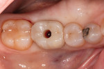 A screw-retained final crown was placed, which would aid in the soft-tissue development of the emergence profile.