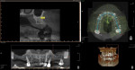 Fig 3. CBCT analysis indicates large maxillary sinuses as well as adequate bone height and width in the premaxilla area for dental implant placement.