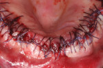 Fig 8. Suturing is performed to maintain a band of at least 2 mm of attached gingiva on the facial aspect of each implant.