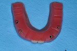 Fig 10. Conventional bite relations are made for the creation of esthetics prior to fabrication of the final zirconia prosthesis.