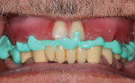 Fig 11. Conventional bite relations are made for the creation of esthetics prior to fabrication of the final zirconia prosthesis.
