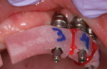 Fig 14. Individual inlay resin jigs are fabricated by the dental laboratory to ensure a passive fit of the final framework.