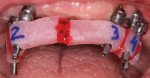 Fig 15. Individual inlay resin jigs are fabricated by the dental laboratory to ensure a passive fit of the final framework.